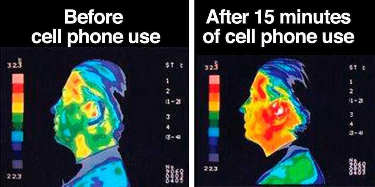 Јасно се види мозак пре зрачења лево) и после зрачења (десно)